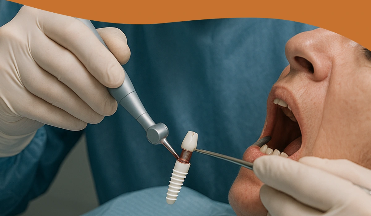 جایگزینی دندان از دست رفته - بهترین روش پر کردن جای دندان